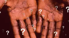 Bệnh đậu mùa khỉ là gì?