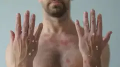 Man with skin lesions