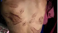 ਕਸ਼ਮੀਰ ਵਿੱਚ ਇੱਕ ਵਿਅਕਤੀ ਦੇ ਲੱਕ ਉੱਤੇ ਤਸ਼ੱਦਦ ਨੇ ਨਿਸ਼ਾਨ