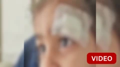 குழந்தையின் காயத்திற்கு ஃபெவிக்விக் பயன்படுத்திய மருத்துவர்கள் - என்ன நடந்தது?