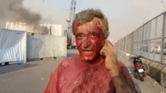 Hombre herido tras la explosión en Beirut.