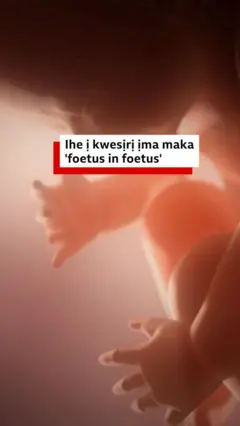 Ihe niile i kwesịrị ịma gbasara ọnọdụ 'foetus in foetus'