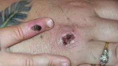 A monkeypox lesion