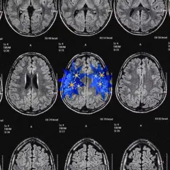 Serie de imágenes de resonancia magnética cerebral con figuras estrelladas azules superpuestas en la región central del cerebro.