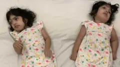 Conjoined Twins ஒட்டிப்பிறந்த இரட்டையர்கள்