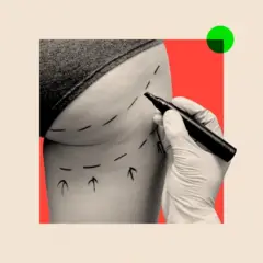 பின்புறப் பகுதியில் அதிக அளவில் டெர்மல் ஃபில்லர்கள் ஊசி மூலம் செலுத்தப்படுகின்றன.