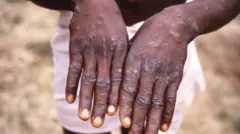 குரங்கம்மை