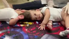 అవిభక్త కవలలు