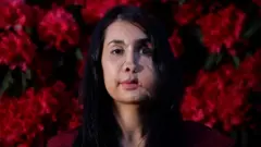 'अफ्गानी महिलाहरू हिंसासँग हार खादैनन्': अनुहारमा गोली हानिएकी महिला