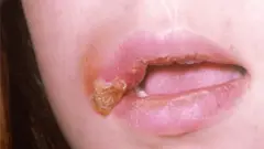 హెర్పెస్ వైరస్/herpes virus వల్ల నోటి పుండ్లు