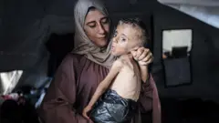 Mãe carregando menino que perdeu um terço do peso corporal devido à desnutrição