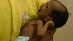કુપોષણ પ્રતીકાત્મક તસવીર