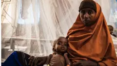 De nombreux enfants souffrent de graves problèmes de santé causés par le manque de nourriture en Somalie.