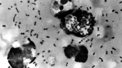 प्लेग भएका व्यक्तिको लिम्फ नोडबाट सङ्कलित नमुना सूक्ष्मदर्शक यन्त्रबाट यस्तो देखिन्छ