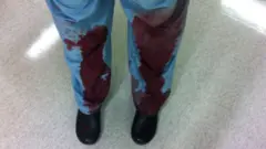 Foto de las piernas ensangrentadas del cirujano David Morris.
