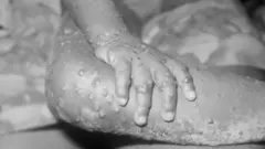 Amaboko n'amaguru by'umwana w'umukobwa w'imyaka ine wo muri Liberia wanduye monkeypox
