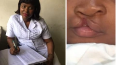 Nurse wey born pikin wit cleft lip