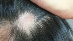 Parte de la cabeza con pelo largo y parte del cuero cabelludo vacía.
