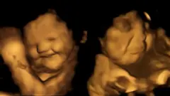 Un feto que parece estar sonriendo y otro que parece estar frunciendo el rostro