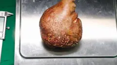 किडनी स्टोन