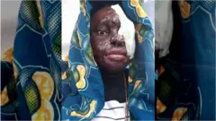 Acid survivor