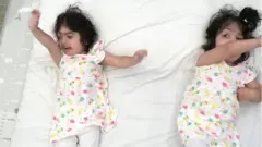 ਸਿਰ ਤੋਂ ਜੁੜੀਆਂ ਜੌੜੀਆਂ ਬੱਚੀਆਂ ਨੂੰ ਕੀਤਾ ਵੱਖ