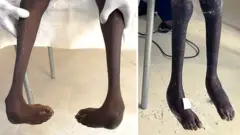 Les pieds de Serigne avant et après le traitement