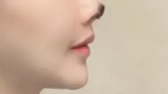 Plastic surgery: Chinese actress Gao Liu necrosis