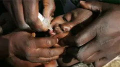 Polio