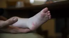 হ্যান্ড ফুট অ্যান্ড মাউথ ডিজিজ