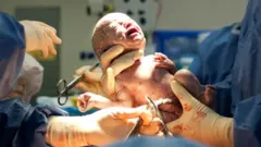 Bebé naciendo a través de una cesárea