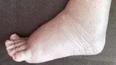 हत्तीरोग