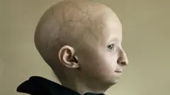 A child with progeria, a rare medical condition, poses for a portrait