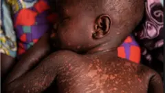 Measles