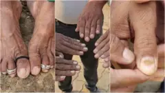 केसगळतीनंतर आता बुलढाण्यात नखगळतीची प्रकरणे समोर येऊ लागली आहेत.