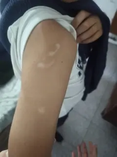 Criança mostra braço com cicatrizes