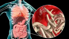 నులి పురుగులు 