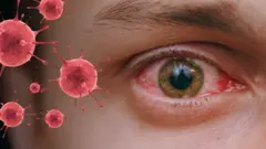 อาการเยื่อบุตาอักเสบ เป็นหนึ่งในอาการที่ไม่พบบ่อยในโควิดสายพันธุ์ต่าง ๆ แต่พบในโควิด XBB.1.16