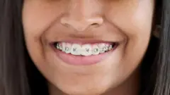Woman with braces
