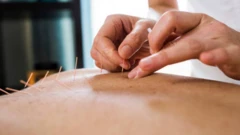 Aworan ẹni to n gba itọju acupuncture