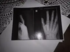 Foto mostra raio-x tirado por Miguel após incidente na escola