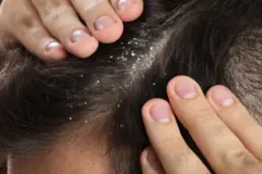ખોડો, સ્વાસ્થ્ય, શિયાળો, Dandruff, ફૂગ, માથામાં ખંજવાળ, વાળ ખરવા, બીબીસી ગુજરાતી 