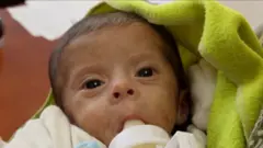 गाजामा कुपोषण भएका एक बालक अस्पतालमा बोतलबाट दूध पिउँदै