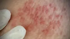 Quadro de herpes zoster