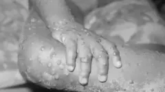 Ọrịa Monkey Pox na-avụkasị ndị mmadụ n'elu ahụ dịka akpịkpa