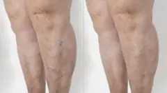 ਵੈਰੀਕੋਜ਼ ਵੇਨਜ਼