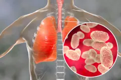 Gawracato waa infekshan halis ah oo haleela cunaha iyo sanka, waxayna sababtaa cuno xanuun, qandho, qanjir barar, iyo tabar dari.