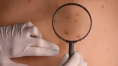 தோல் புற்றுநோய் யாருக்கெல்லாம் ஏற்படும்? அறிகுறிகள் என்ன?