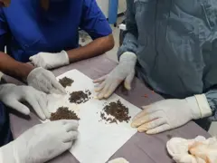 ከ40 ዓመቷ ሴት የወጣው የሐሞት ጠጠር 