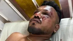 Vishwash Kumar Ramesh após acidente aéreo, com rosto ferido e marcas de sangue